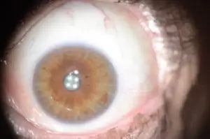 Brown and green iris contact lens with a clear central area, likely silicone hydrogel material.