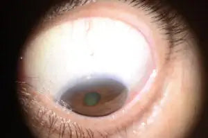 Green contact lens with clear plastic material